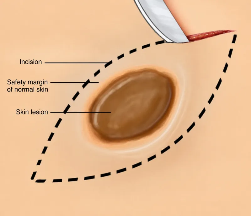 Excisional Biopsy Technique