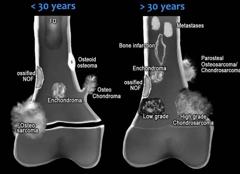 Bone tumors by age: <30 vs >30 years
