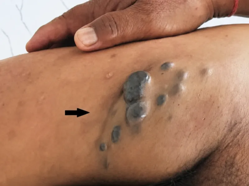 Clinical photographs showing different nodular tropical skin diseases
