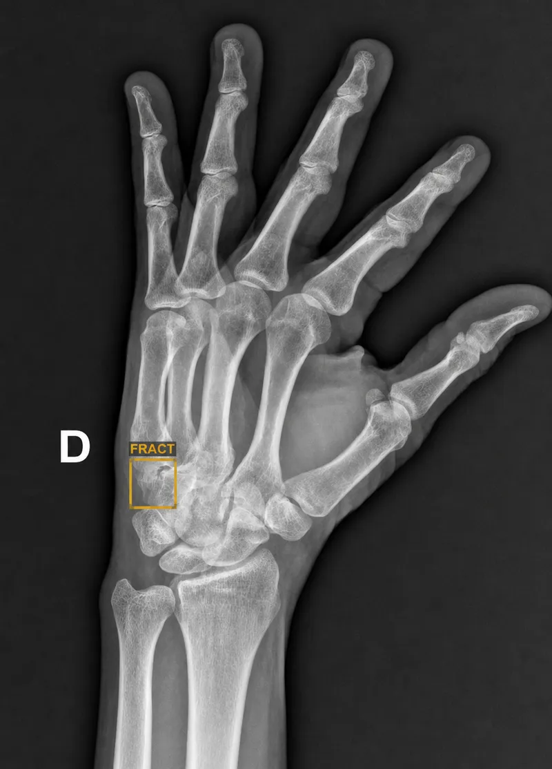 AI-detected scaphoid fracture on wrist X-ray