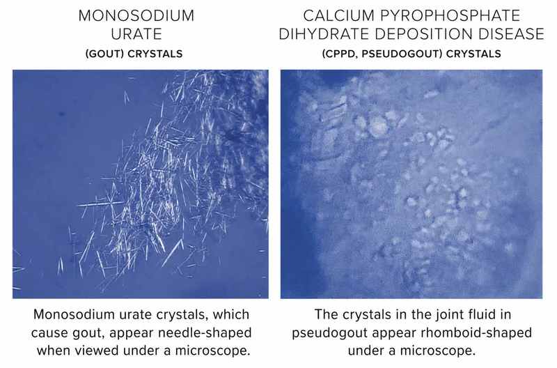 Monosodium urate vs CPPD crystals