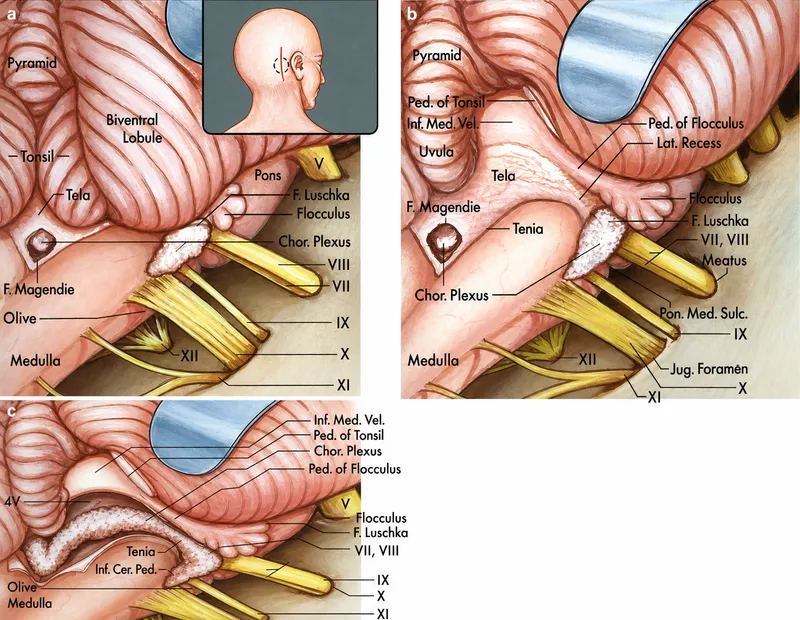 CPA Anatomy and Cranial Nerve Origins