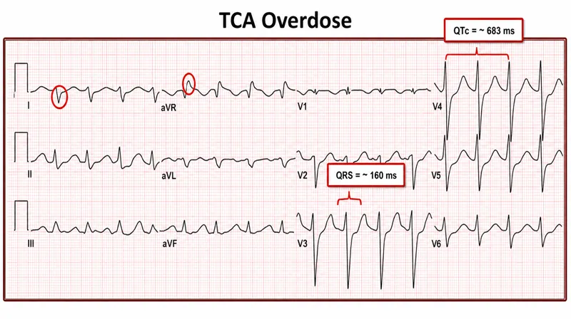ECG: QRS prolongation in TCA overdose