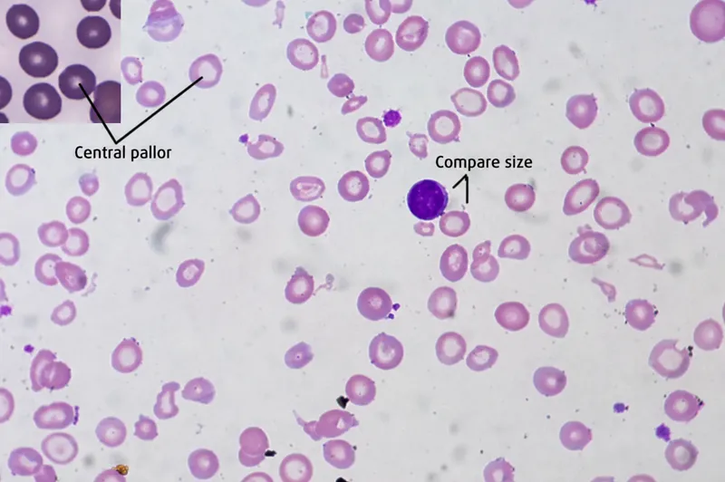 Peripheral blood smear showing microcytic hypochromic red blood cells in iron deficiency anemia
