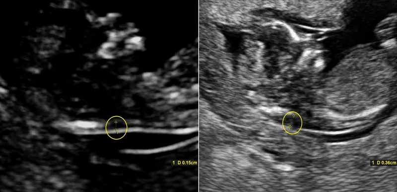 Normal vs. Increased Nuchal Translucency Ultrasound