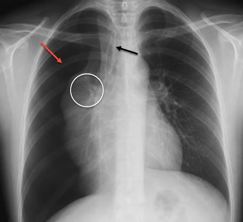 Post-pneumonectomy chest X-ray with annotations
