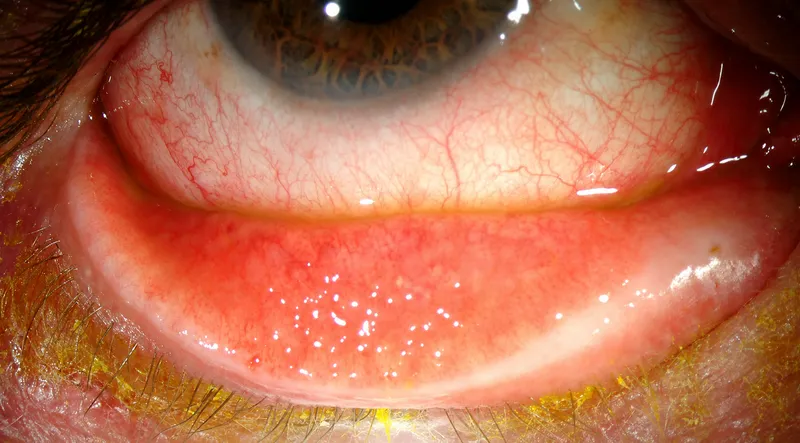 Follicular reaction in viral conjunctivitis