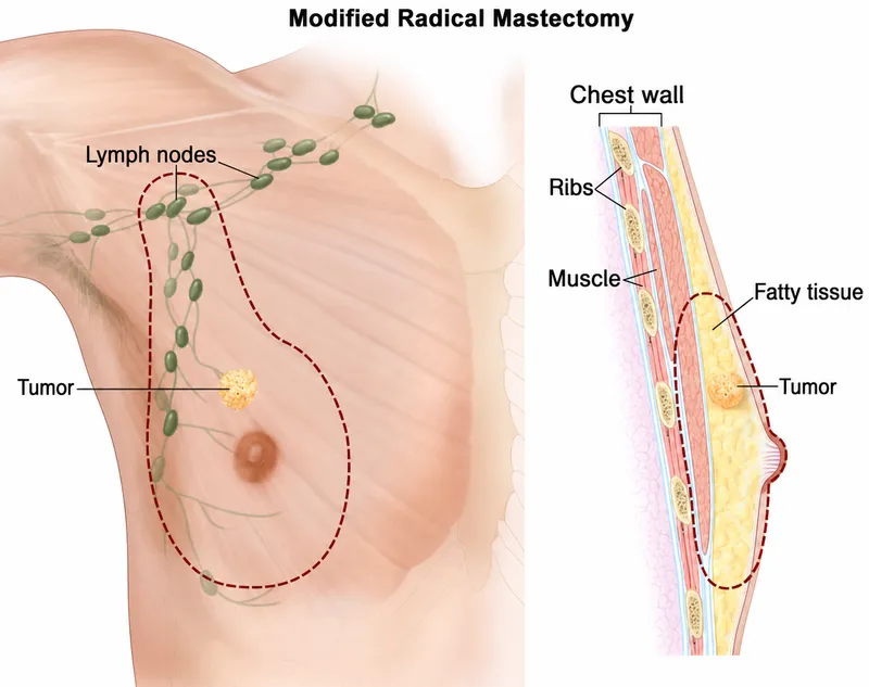 Modified Radical Mastectomy for Male Breast Cancer