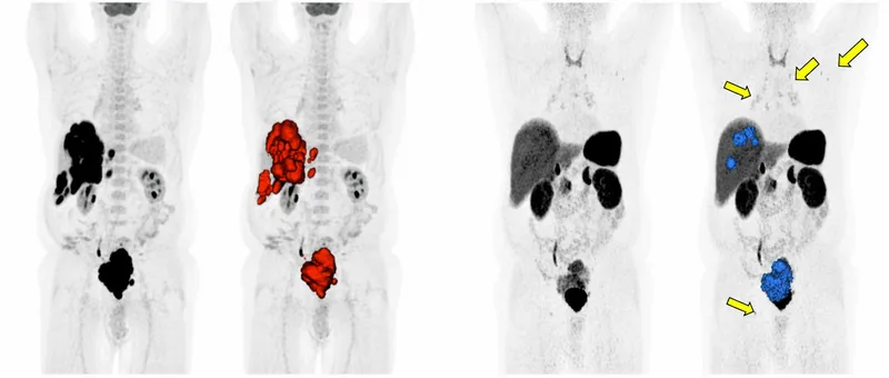 Gallium-68 DOTATATE PET CT of neuroendocrine tumors