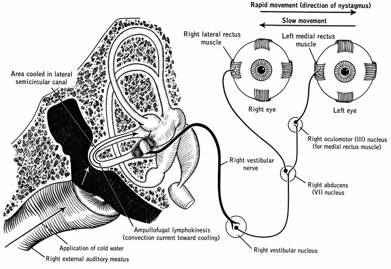 Bithermal Caloric Test Procedure and Nystagmus