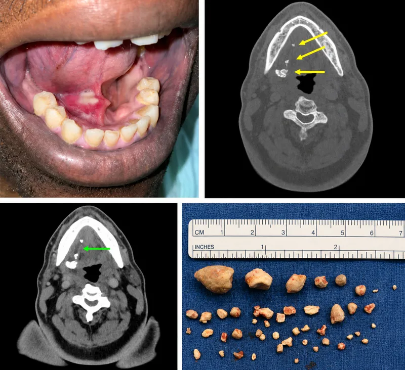 Sialolithiasis: Clinical, CT, and Excised Stones