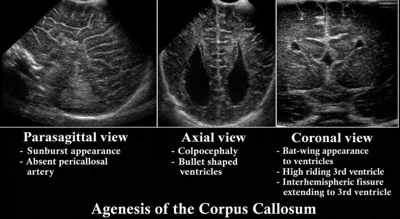Agenesis of Corpus Callosum Ultrasound Views