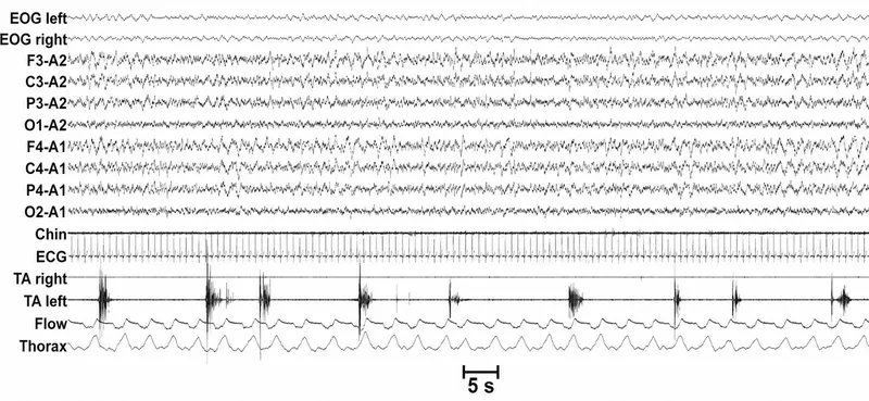 Polysomnography of Periodic Limb Movement Disorder