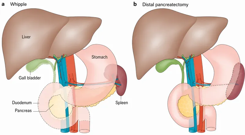Whipple and Distal Pancreatectomy Diagrams