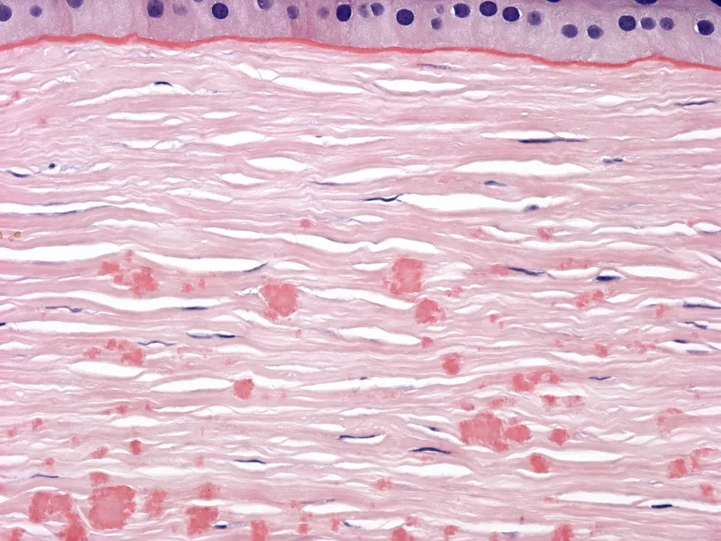Macular Corneal Dystrophy Histopathology