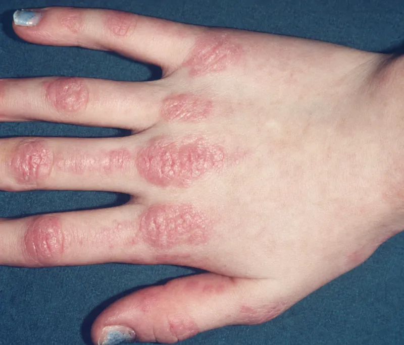 Gottron's papules on hand in Dermatomyositis