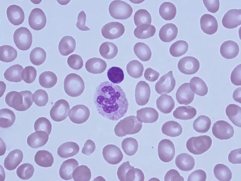 Peripheral smear: megaloblastic anemia