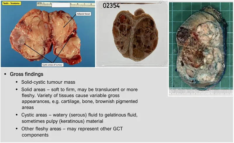 Testis Teratoma Gross Pathology