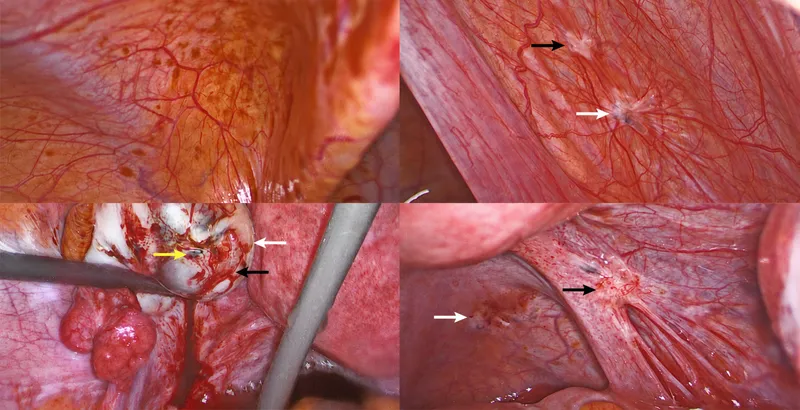 Laparoscopic views of peritoneal endometriosis lesions