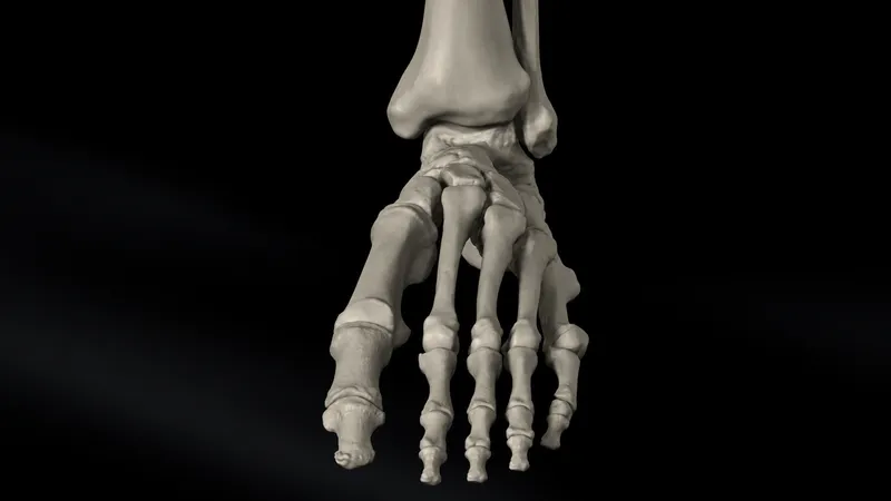 1st Metatarsal Phalangeal Joint Arthrodesis