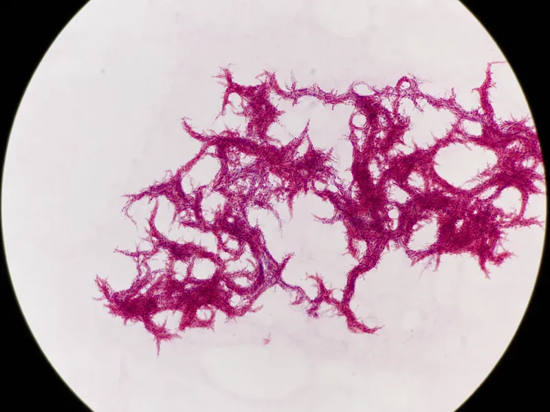 M. tuberculosis Kinyoun stain showing cording