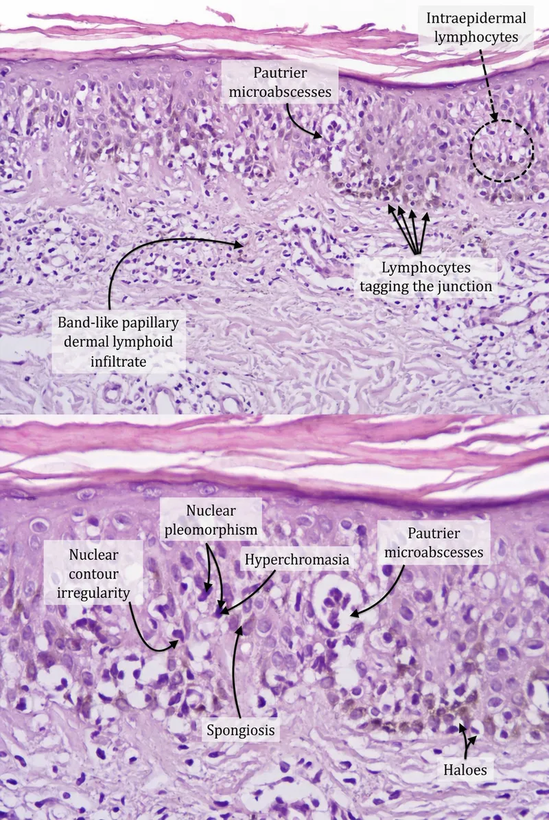 Mycosis Fungoides Histology: Pautrier's Microabscess