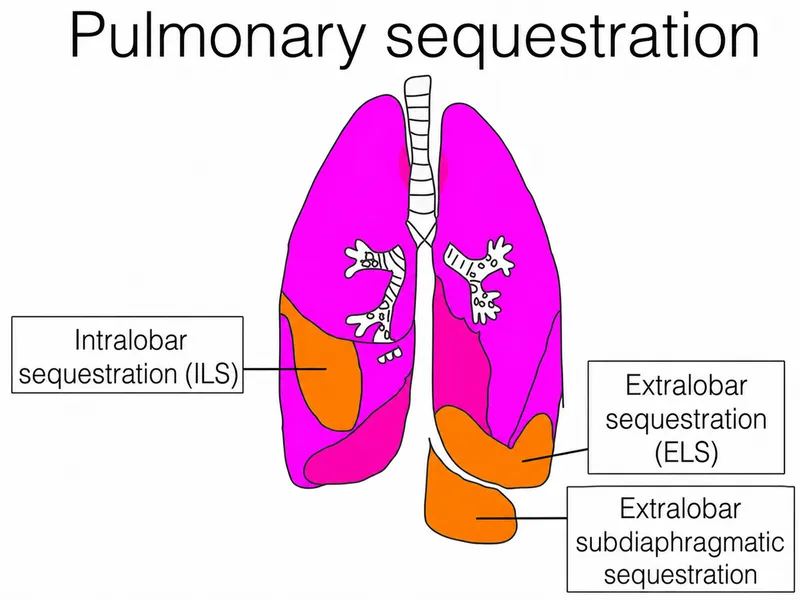 Pulmonary Sequestration Types: Intralobar and Extralobar