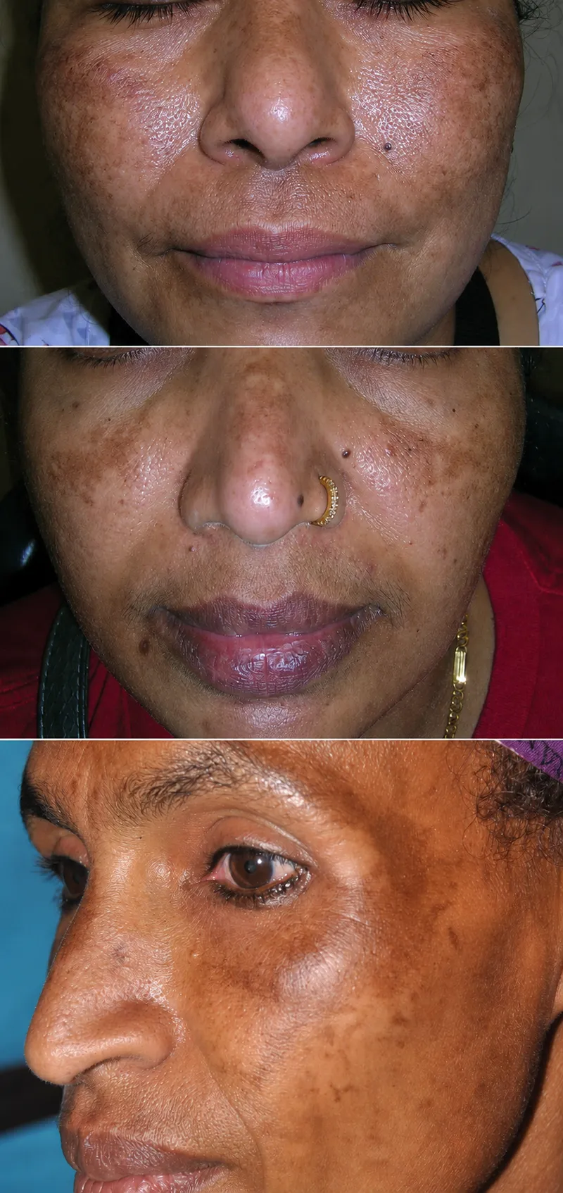 Melasma on Indian skin type