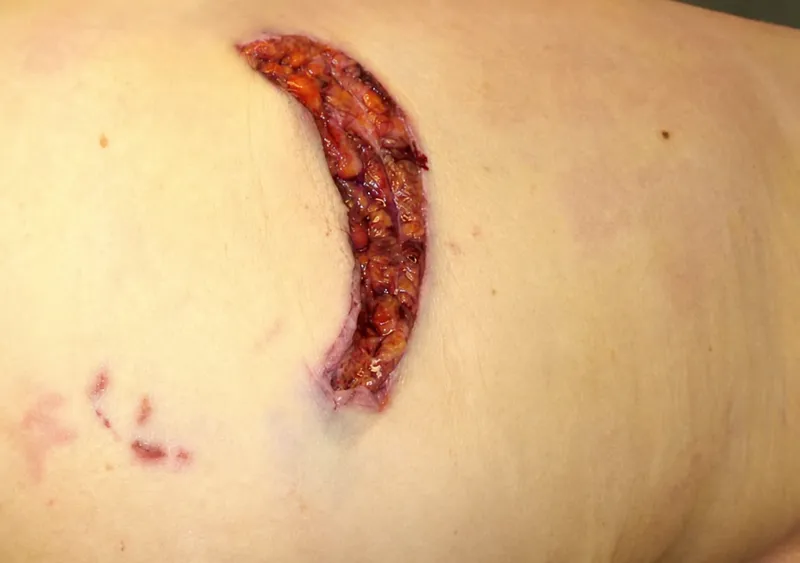 Sharp force trauma to soft tissue with ruler for scale