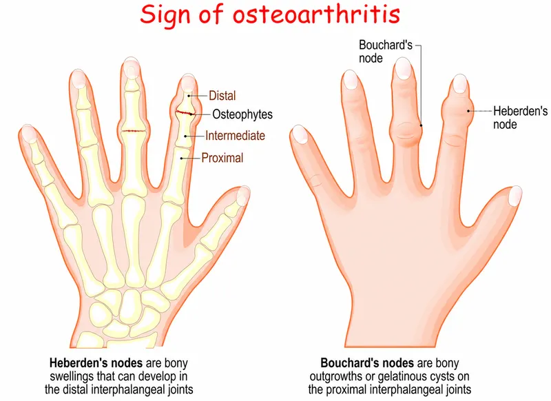 Heberden's and Bouchard's nodes