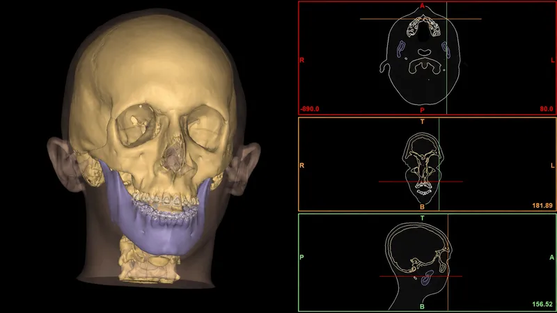 3D surgical planning software showing bone reconstruction