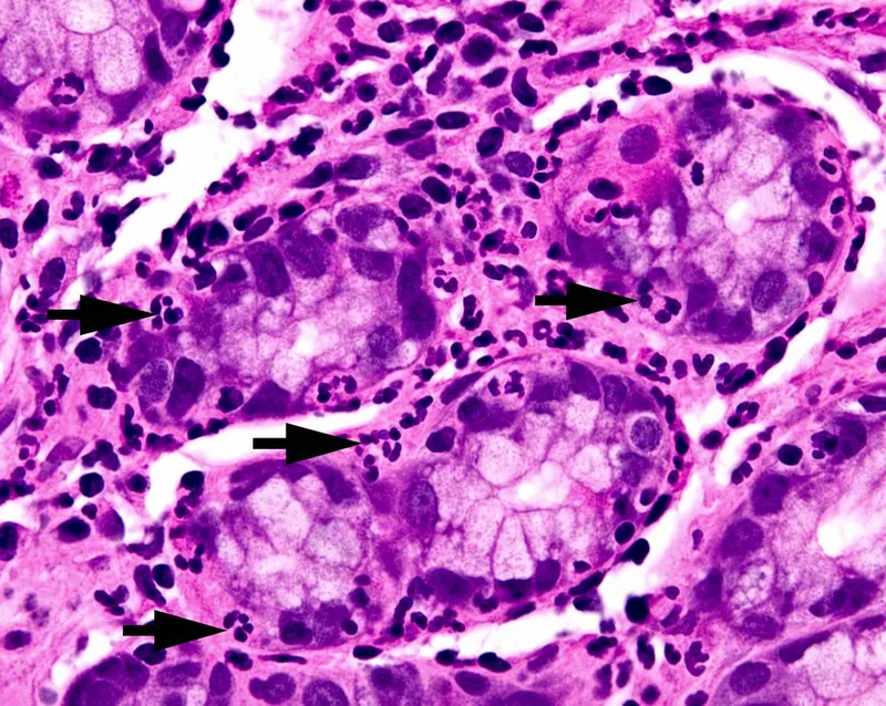 Acute gastritis with neutrophils