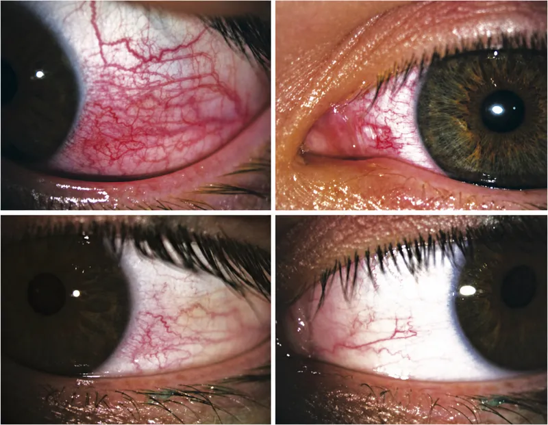 Before and after phenylephrine test showing differential response in episcleritis versus scleritis