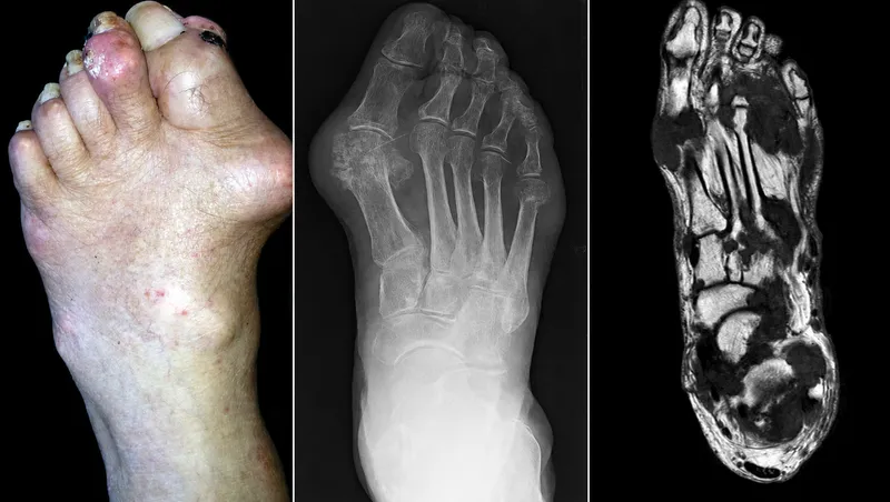 Foot and ankle arthritis: clinical signs, X-ray, and MRI
