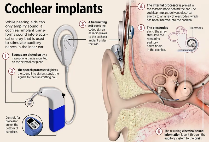 Cochlear implant external and internal components