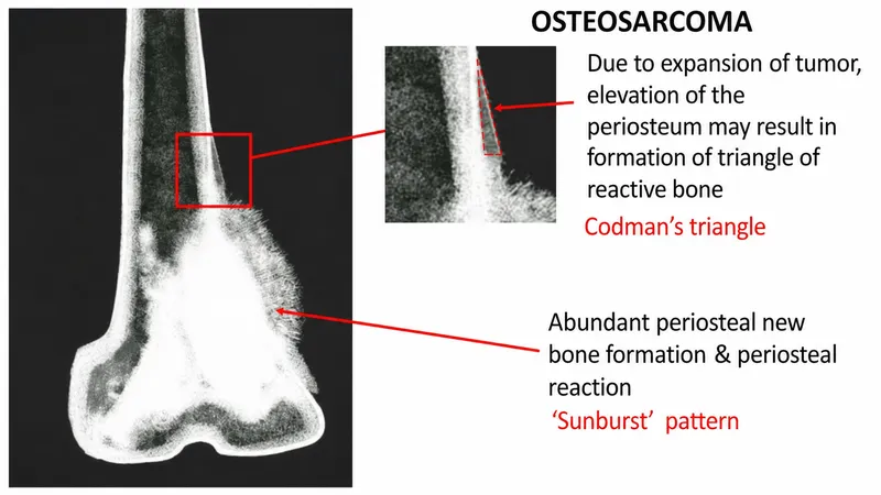 Osteosarcoma X-ray: Sunburst pattern & Codman's triangle