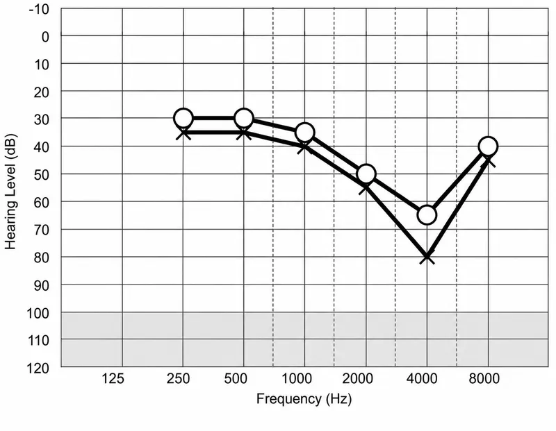 Audiogram showing 4kHz notch in NIHL