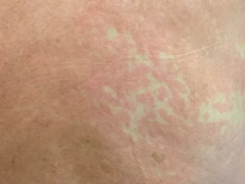 Hermann's rash (islands of white in a sea of red)