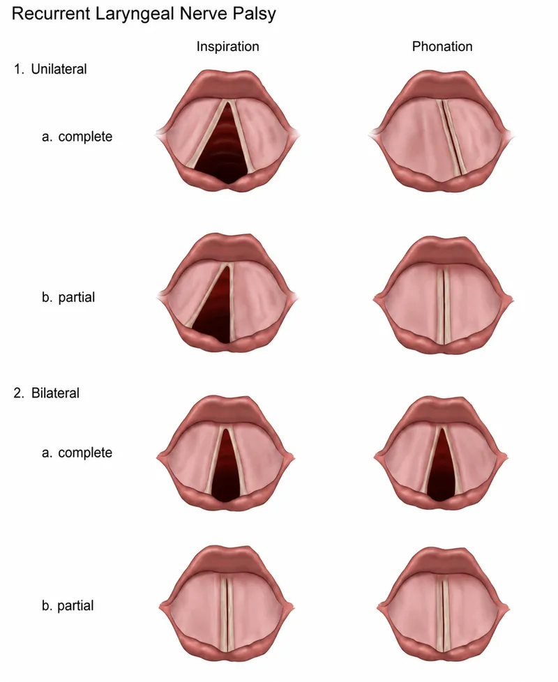 Laryngoscopic views of vocal cord paralysis