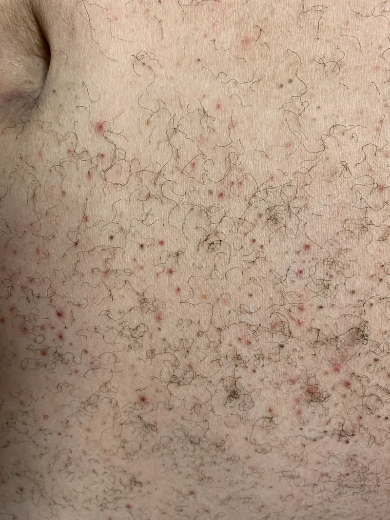 Scurvy: Corkscrew hairs and perifollicular hemorrhage