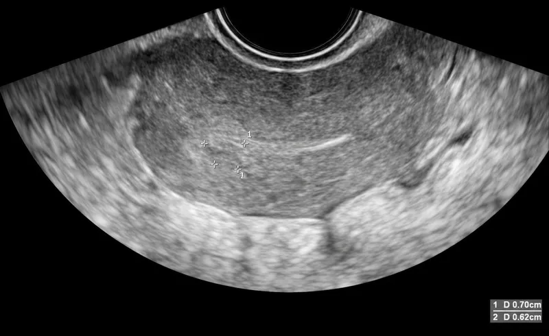 Ultrasound of retained products of conception