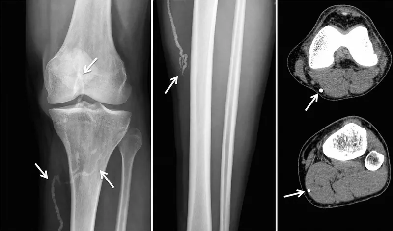 Calcified Guinea worm near knee joint on X-ray and CT