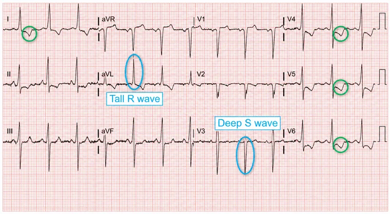 Figure 2: ECG showing left ventricular hypertrophy with strain pattern