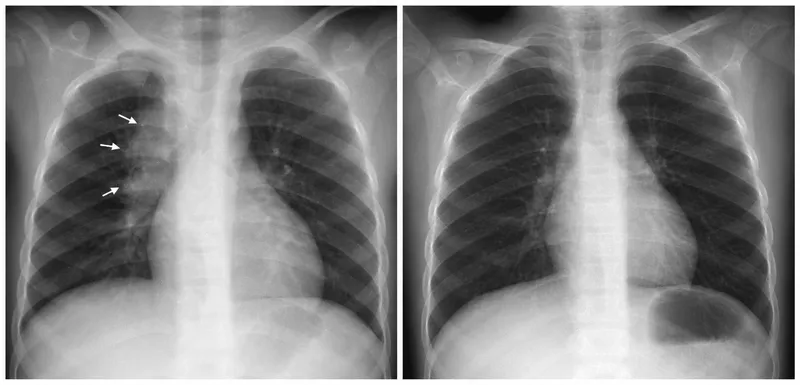 Pediatric TB Chest X-ray with hilar lymphadenopathy