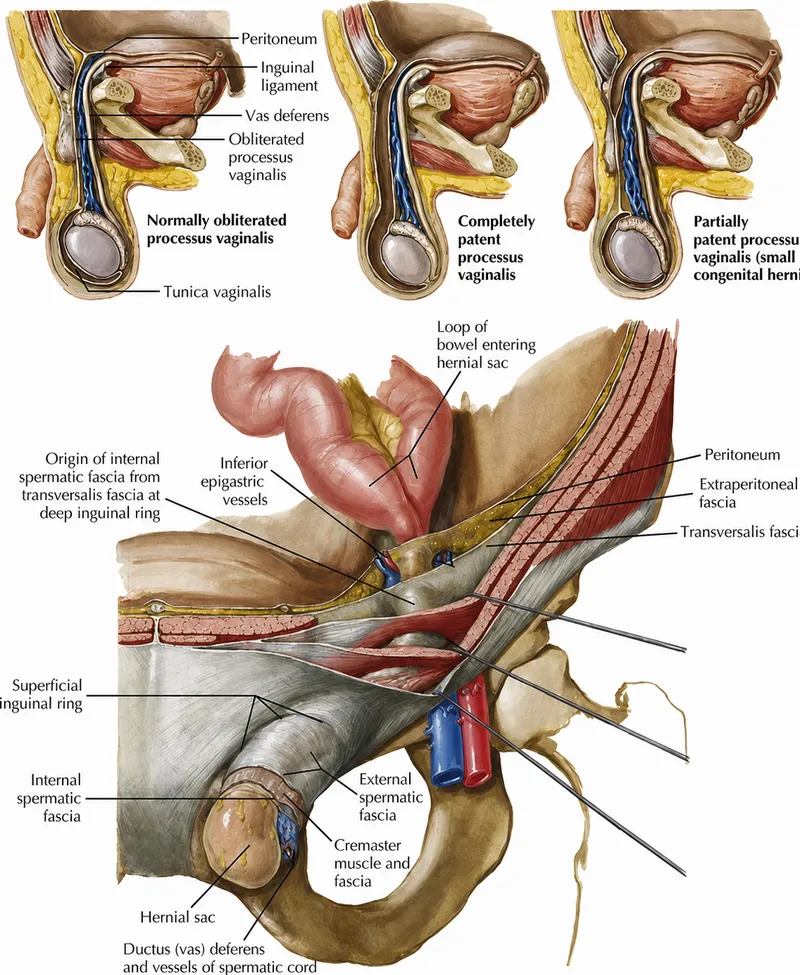 Pediatric Inguinal Hernia Anatomy & Processus Vaginalis