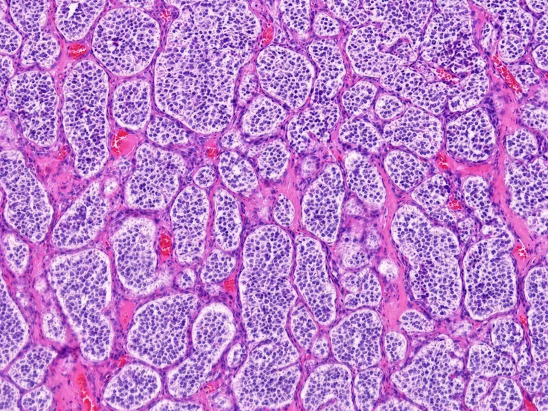 Pheochromocytoma Histopathology: Zellballen Pattern