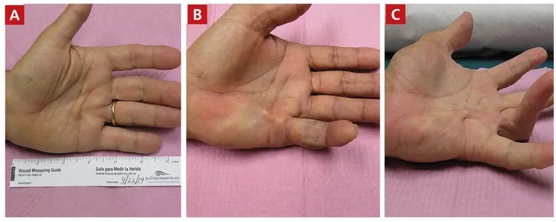 Dupuytren's disease: nodule, cord, contracture