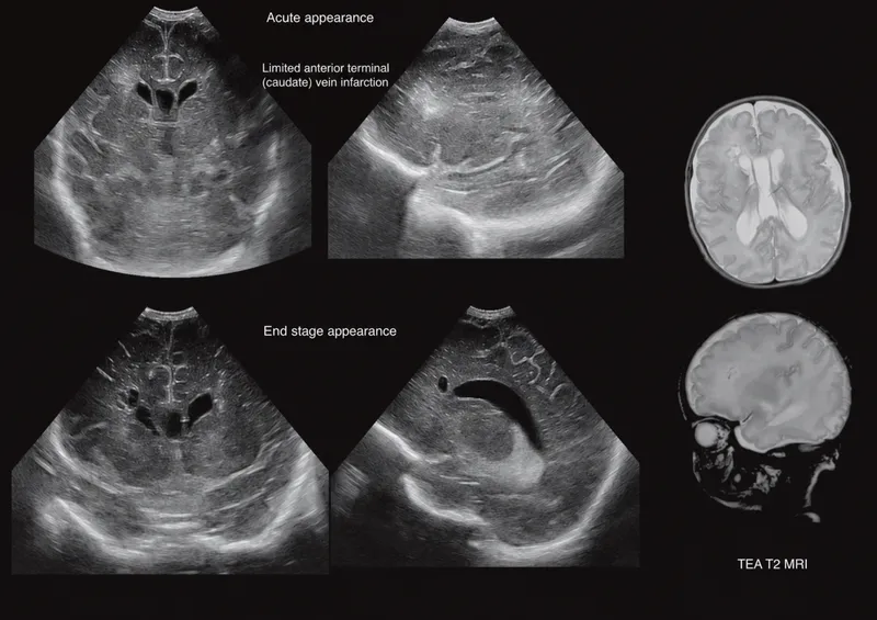 Neonatal brain ultrasound: GMH/IVH evolution to porencephaly
