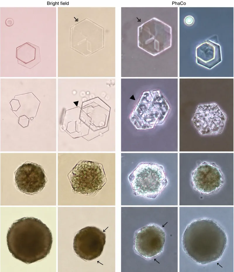 Hexagonal cystine crystals in urine sediment