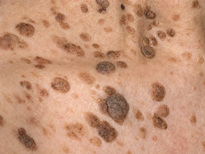 Leser-Trelat sign: multiple seborrheic keratoses